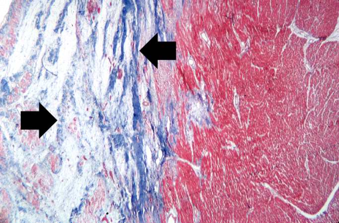 This is a photomicrograph of a trichrome-stained section of heart containing an old healed myocardial infarction. The scar is composed of mature fibrous connective tissue (arrows).