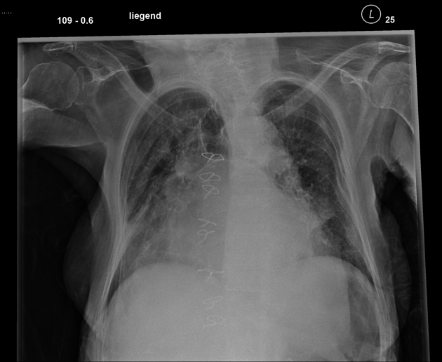 File:Left atrial enlargement with splaying of carina.jpg