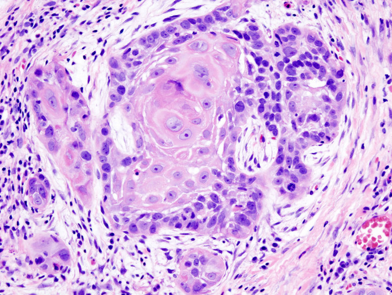 Biopsy of a highly differentiated squamous cell carcinoma of the mouth.Haematoxylin & eosin stain.