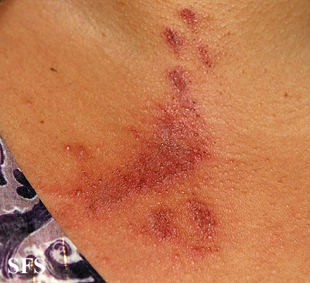 Paederus dermatitis. Adapted from Dermatology Atlas.[9]