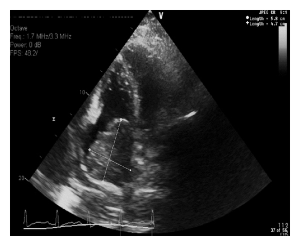 A comprehensive 2 dimensional M-mode color flow and Doppler echocardiography reveals a normal left ventricular systolic function (EF 60–69%). A large right atrial mass measuring  cm almost fills the right atrium and extends into the tricuspid valve causing tricuspid regurgitation.[5]