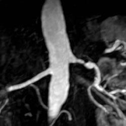 File:Renal artery stenosis 012.jpg