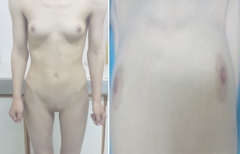 Normal female morphotype but absence of pubic and axillary hair [18]