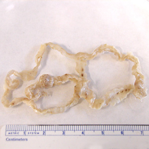 Adult D. latum containing many proglottids Source: https://www.cdc.gov/dpdx/diphyllobothriasis/index.html (Image courtesy of the Florida State Public Health Laboratory).