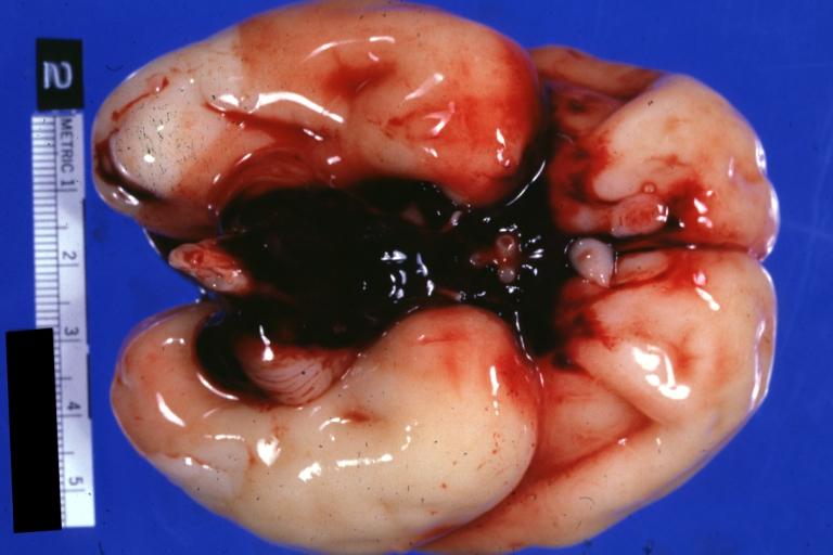 Brain: Intraventricular Hemorrhage: Gross natural color blood filled basilar leptomeninges characteristic of external brain appearance with intraventricular hemorrhage