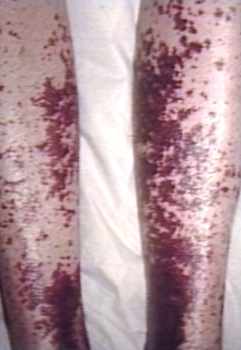 Skin:Leucocytolastic vasculitis; legs