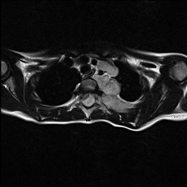 Neuroblastoma observed on transverse MRI as a large mass which extends into the spinal canal and causes significant cord compression[3]
