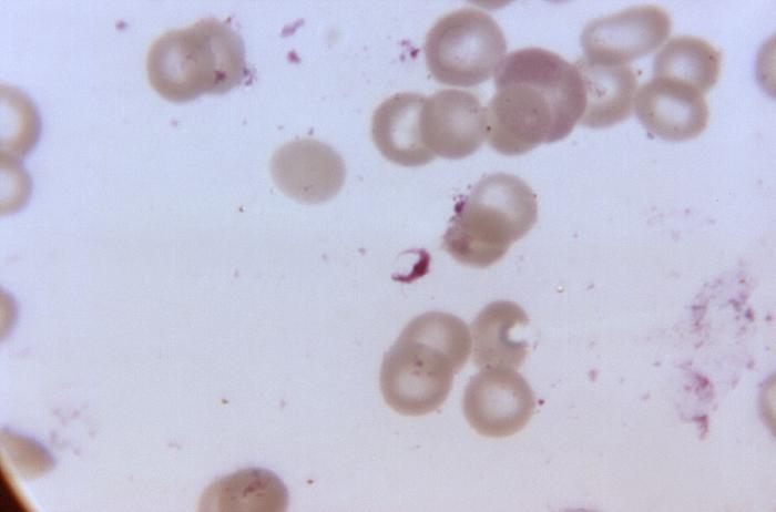 Malaria (organisms in cells)