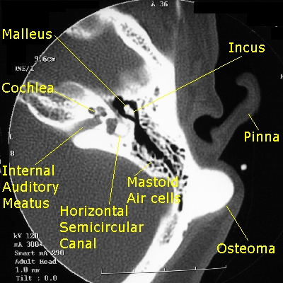 Axial CT scan of the temporal bones showing a left mastoid osteoma[2]