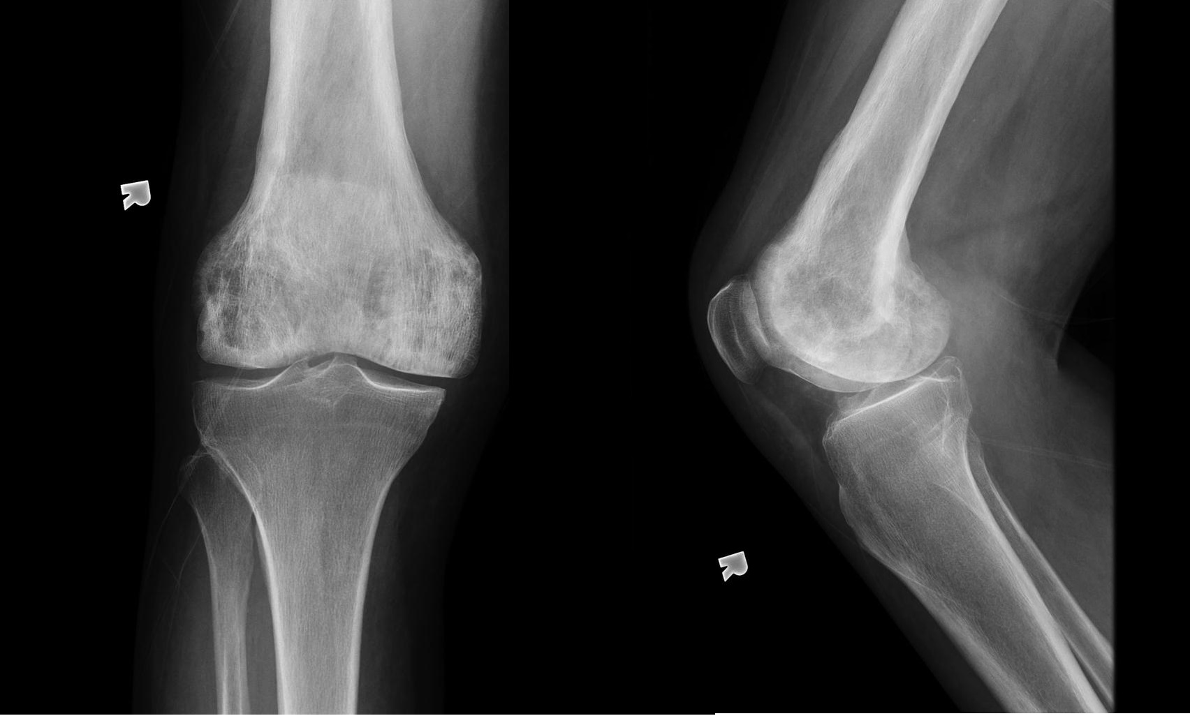 File:Paget-disease-of-the-knee.jpg