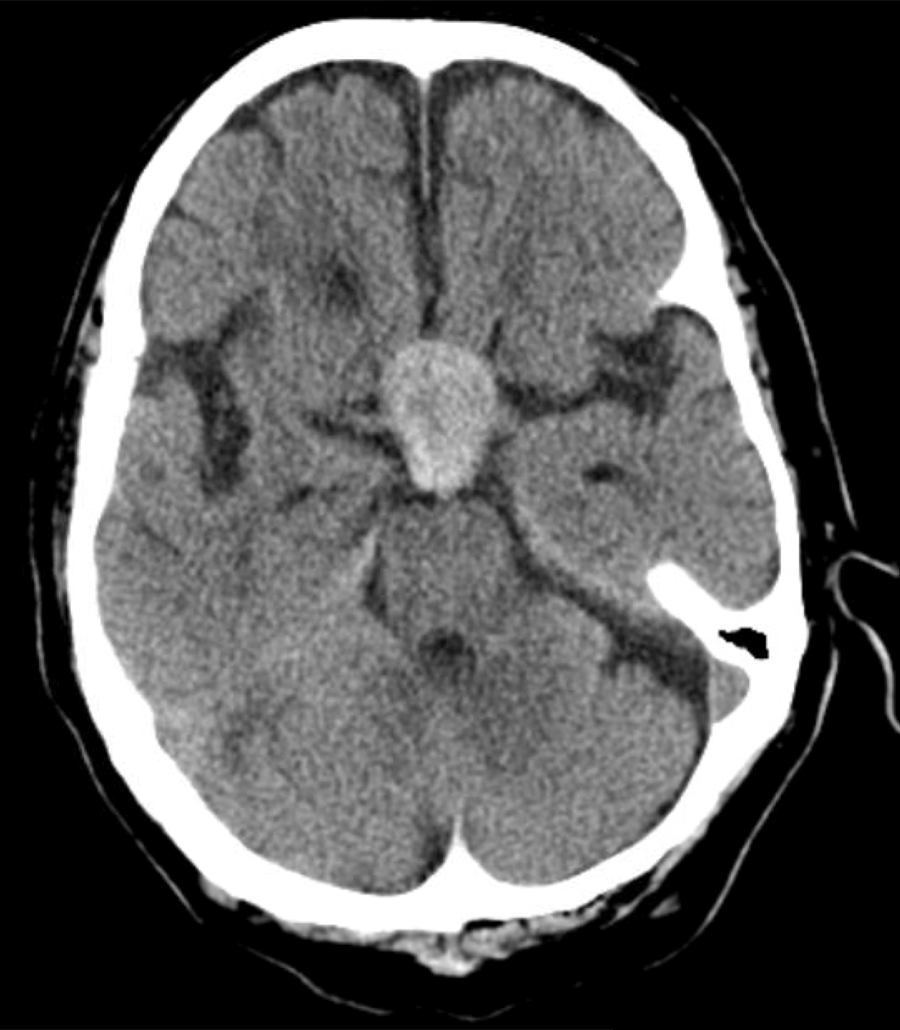 Pituitary adenoma compression of surrounding structures