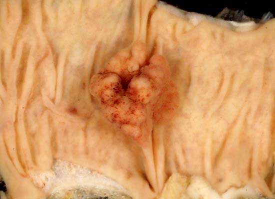 Adenomatous polyp of colon: This 2.5 cm adenomatous polyp was serendipitously found in a right colectomy specimen. The colon was removed to bypass an extrinsic obstruction caused by metastatic ovarian cancer. In the picture above, the long axis of the opened bowel is horizontal, and the mucosa is viewed en face.