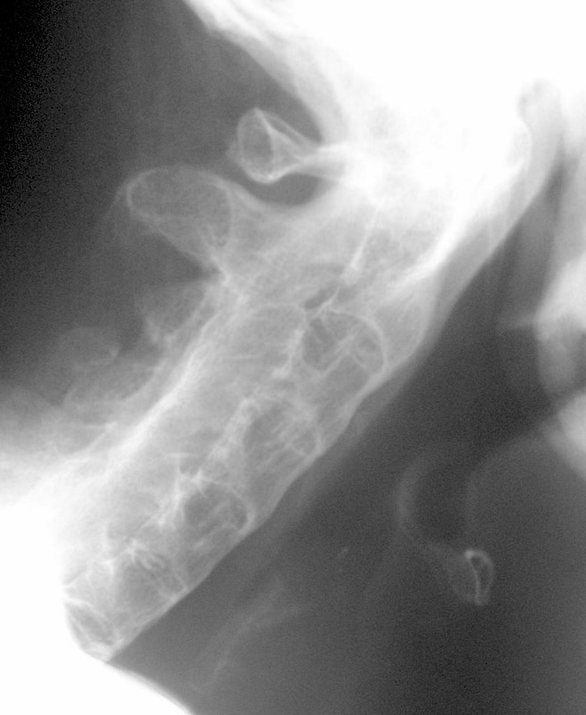 File:Ankylosing spondylitis Bamboo spine.jpg