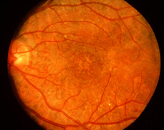 "Salt and pepper" retinopathy is the most common ocular manifestation of CRS. - By Jonathan Trobe, M.D. - University of Michigan Kellogg Eye Center - http://www.kellogg.umich.edu/theeyeshaveit/congenital/retinopathy.html, CC BY 3.0, https://commons.wikimedia.org/w/index.php?curid=16115881