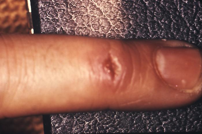 This patient presented with secondary syphilitic lesions on her face. The second stage starts when one or more areas of the skin break into a rash that appears as rough, red or reddish-brown spots both on the palms of the hands and on the bottoms of the feet. Even without treatment, rashes clear up on their own. Adapted from CDC