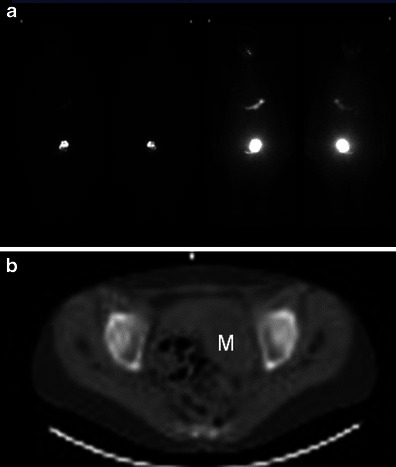 File:Struma ovarii - Scintigraphy.jpg