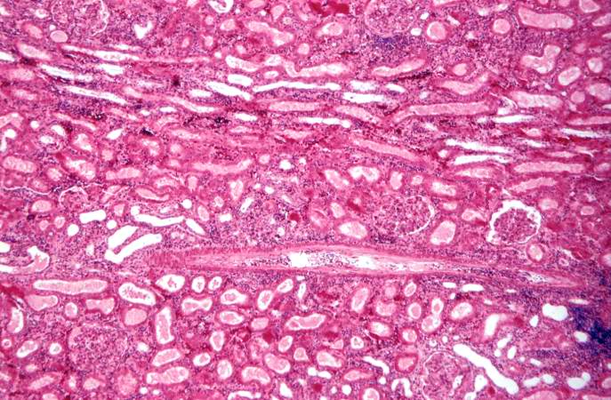 This is a higher-power photomicrograph demonstrating the cellular infiltrate within the interstitium and around the small blood vessel in the center of the image.