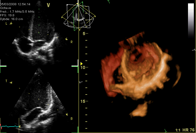 Echocardiogram showing normal valvular function. The aortic valve can be seen in the upper part of the righthand image.