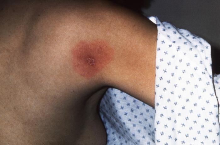 Posterior right shoulder region of a patient who’d presented with the erythema migrans (EM) rash characteristic of what was diagnosed as Lyme disease, caused by Borrelia burgdorferi. From Public Health Image Library (PHIL). [2]