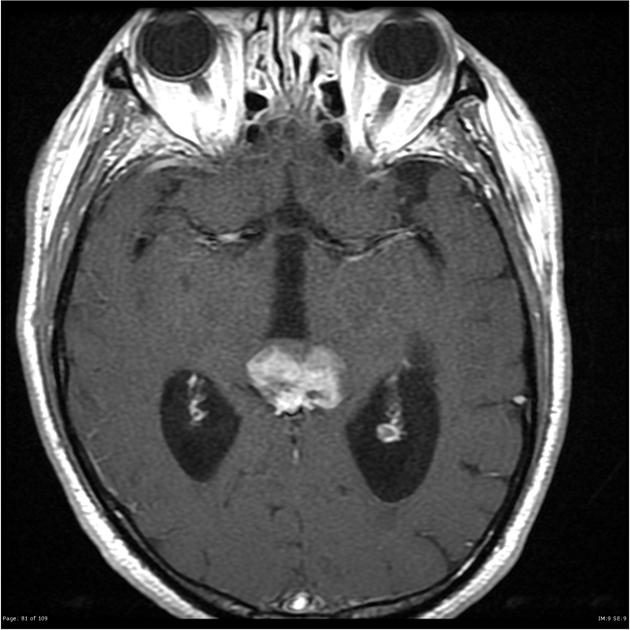 Axial T1 with contrast demonstrating an irregular heterogenous enhancing pineal mass with several tiny cystic foci and eccentric coarse calcifications. There is moderate mass effect on the adjacent tectum and vermis, with loss of definition and possible parenchymal invasion on the left. There is associated aqueduct compression with moderate hydrocephalus.[19]