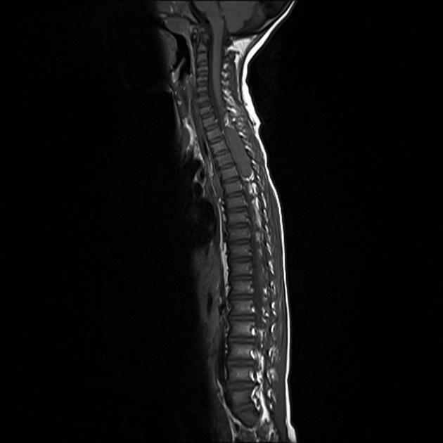 Neuroblastoma observed on sagittal MRI as a large mass which extends into the spinal canal and causes significant cord compression[3]