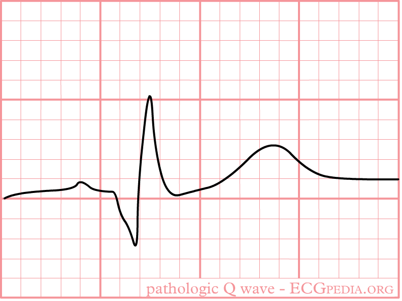Pathologic Q wave