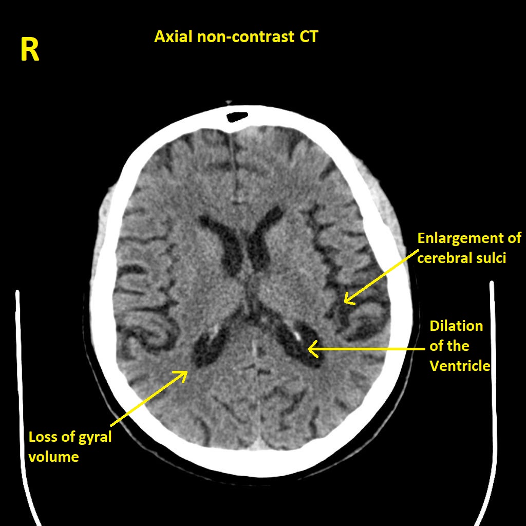 File:Alzheimers disease axial non contrast CT.jpg