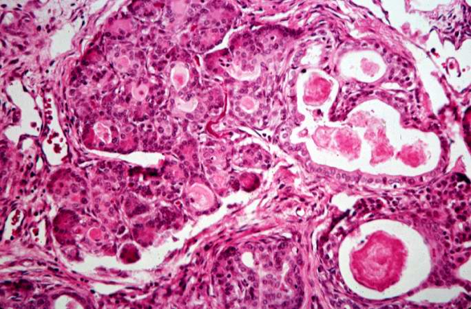 This high-power photomicrograph shows more clearly these variably-sized cystic spaces within the acinar pancreas.