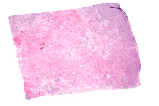 This is a low-power photomicrograph of decalcified histologic section from this tumor. Note the blue color (cell nuclei stain blue) of much of this section indicating the increased cellularity of the tumor.