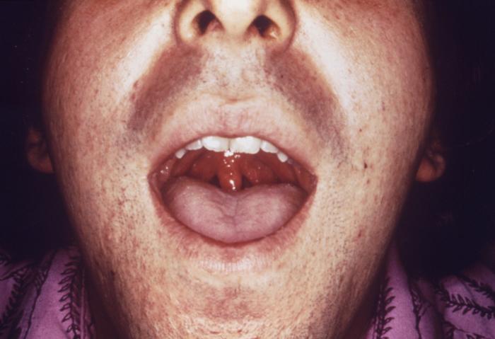 This male presented with a purulent penile discharge due to gonorrhea with an overlying penile pyodermal lesion.Pyoderma involves the formation of a purulent skin lesion, in this case located on the glans penis, and overlying the sexually transmitted disease gonorrhea.Adapted from CDC