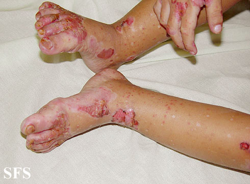 Acrodermatitis enteropathica. [http://www.atlasdermatologico.com.br/disease.jsf?diseaseId=12