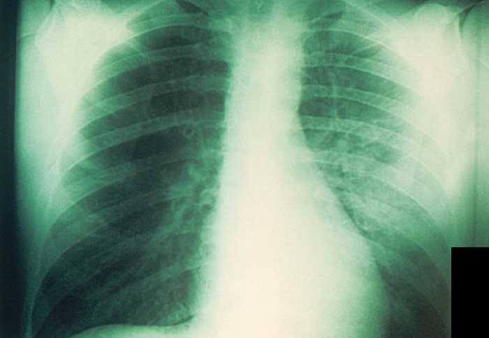 Chest x-ray of a plague patient revealing bilateral infection, greater on the patient's left side, which was diagnosed as a case of pneumonic plague, caused by Yersinia pestis. From Public Health Image Library (PHIL). [13]