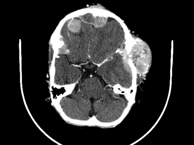 Neuroblastoma observed on CT scan associated with multiple osseous lytic metastases involving the calvaria, skull base, orbit, and mandible with epidural and extra cranial extension[2]