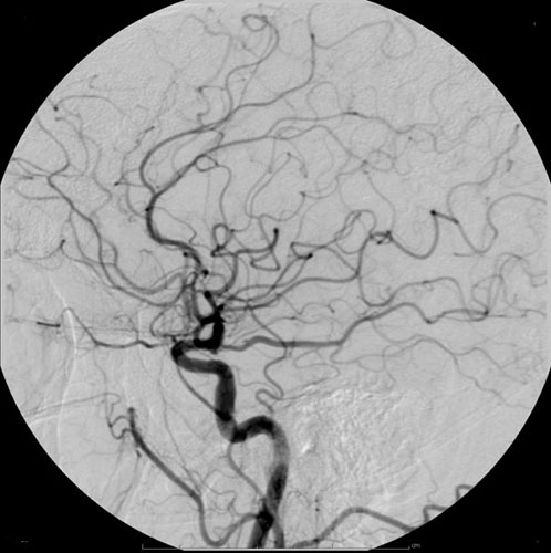 Example of Iodine based contrast in Cerebral Angiography