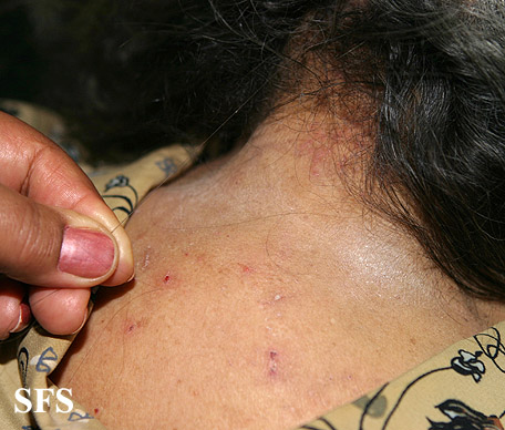 Pediculosis capitis. Adapted from Dermatology Atlas.[12]
