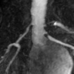 File:Renal artery stenosis 025.jpg