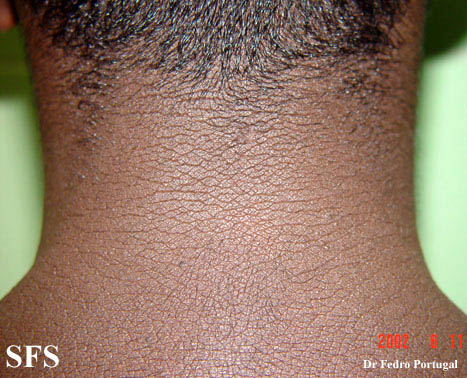 Acanthosis nigricans. Adapted from Dermatology Atlas.[2]