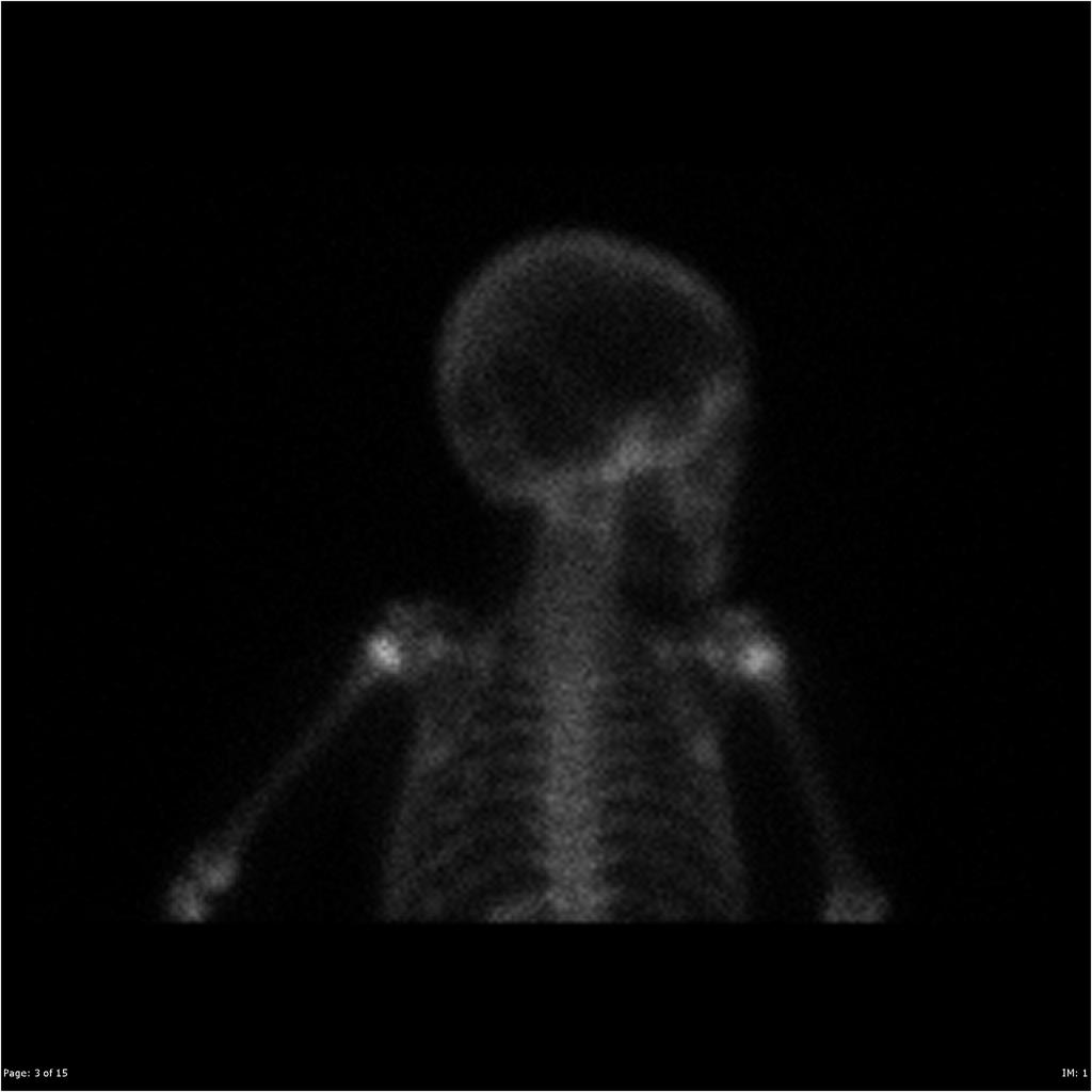 File:Burkitt's lymphoma bone scan 01.jpg