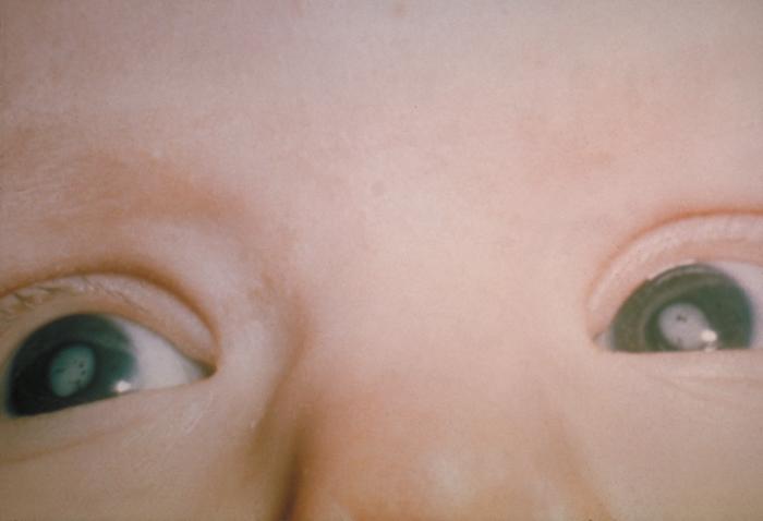 A child with congenital cataracts as a consequence of CRS. - By CDC - PHIL, Center for Disease Control (CDC) -- ID# 713, Public Domain, https://commons.wikimedia.org/w/index.php?curid=12841764