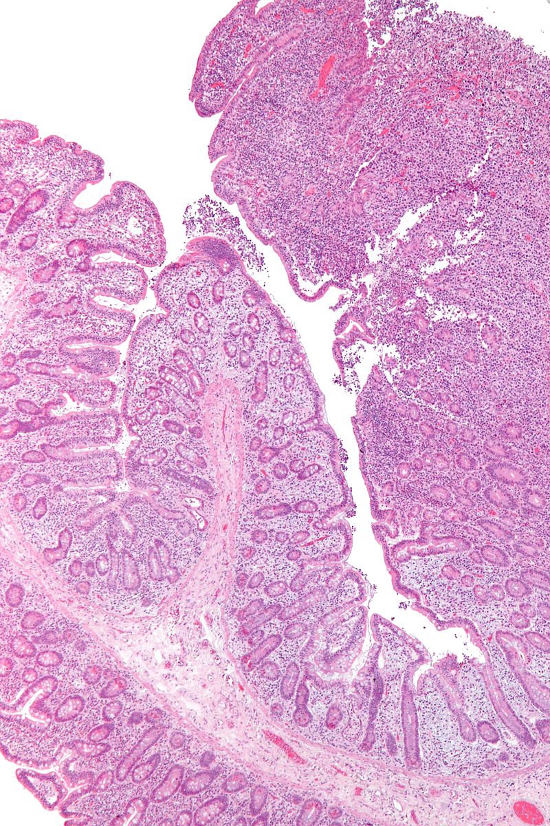 File:Enteropathy-associated T cell lymphoma - low mag.jpg