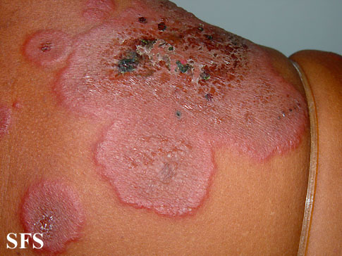 .:Erythema multiforme Adapted from Dermatology Atlas.