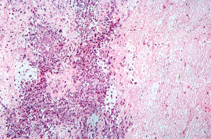 This is a high-power photomicrograph of decalcified histologic section showing the cellularity of the tumor.