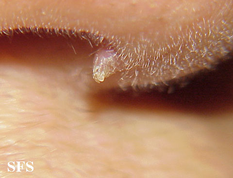 Warts formis. Adapted from Dermatology Atlas.[1]