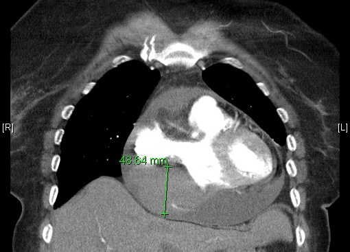 CTA coronal section showing cardiac mass external to the right atrium (with measurements).