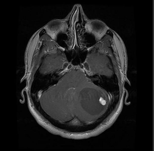 File:Hemangioblastoma-002.jpg