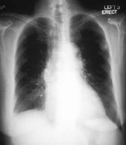 Malignant solitary pulmonary nodule: The patient is a 67 year old woman with a solitary pulmonary nodule on a recent chest x-ray. A retrospective review of prior chest x-rays suggests that this is nodule is of recent origin. This lesion was felt to be too peripheral for reliable bronchial wash findings. Concern over potential sampling error associated with needle biopsy prompted a referral for PET imaging to rule out a malignant process.