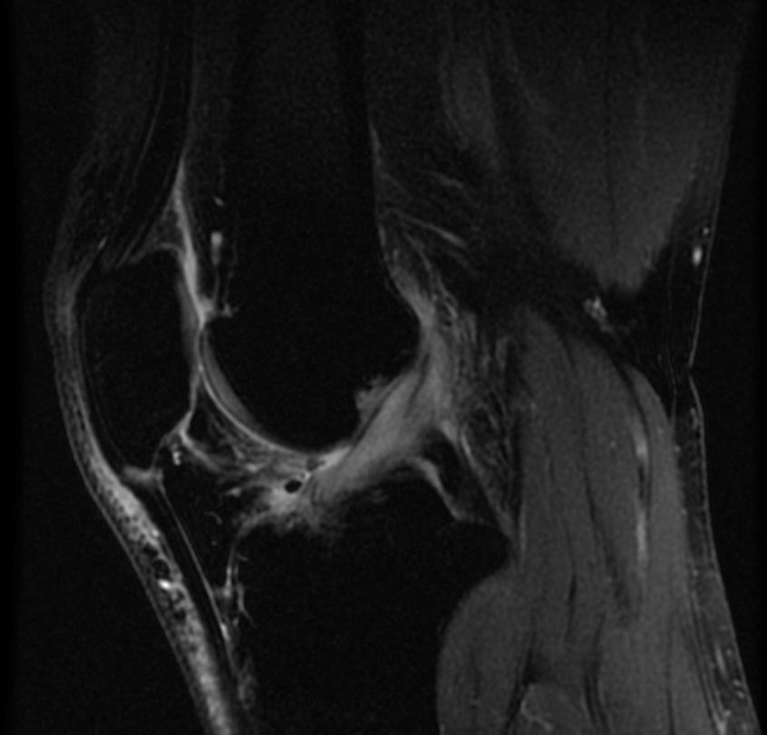 File:Mucoid degeneration of the anterio cruciate ligament MRI 002.jpg
