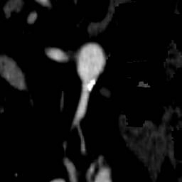 File:Renal artery stenosis 035.jpg