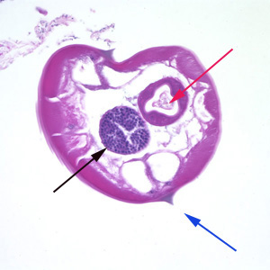Pinworms are sometimes diagnosed incidentally by pathology. Micrograph of male pinworm in cross-section. Alae (blue arrow), intestine (red arrow) and testis (black arrow). H&E stain.