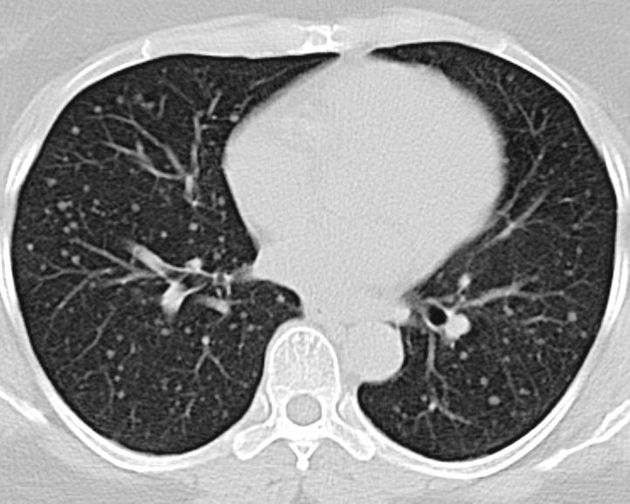 File:Follicular thyroid cancer lung metastasis.jpeg